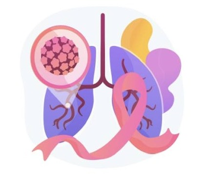 Курение – основная причина рака легких